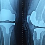 Best Orthopedic Surgeon Near Me in Kolkata - Dr. Abhijit Sen